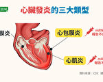 【疫情6.24】FDA：mRNA疫苗恐致心臟發炎