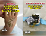 智能手表爆炸 福建一4岁女童被严重烧伤