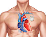 新发明心脏起搏器 不用取出可在体内溶解