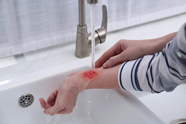 用干净的冷水轻轻的冲洗烫伤、烧伤伤口，让温度急速下降让而减低高温造成的伤害。(shutterstock)