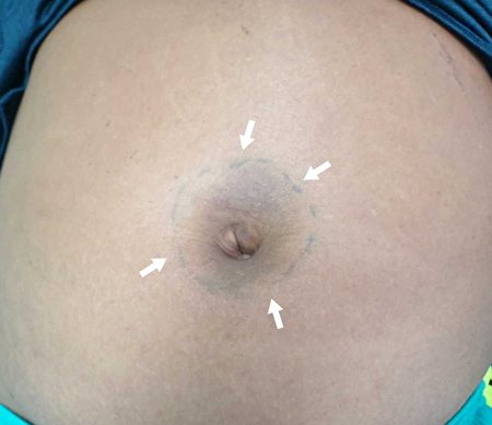 2名男性肚脐出现瘀青竟是罹患肝癌。