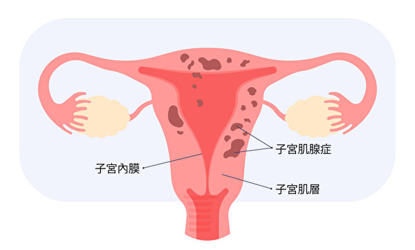 當子宮內膜出現在子宮肌層時，就被稱為子宮肌腺症或子宮肌腺瘤。(Shutterstock)