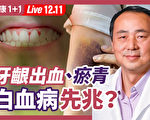 【直播】牙龈出血、瘀青 是白血病先兆？