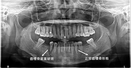齿槽骨严重破坏及正常齿槽骨。