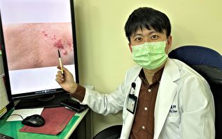 帶狀皰疹長臉上  醫師：恐失明