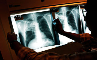 衛生局：肺結核病例數量自2019年以來已減少5%