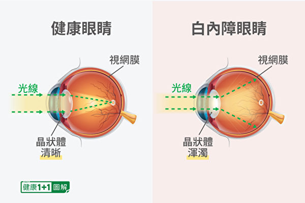 白内障是眼睛晶状体的渐进性混浊，让视力变得模糊。（健康1+1／大纪元）