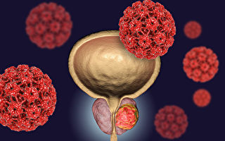 研究發現前列腺癌與五種細菌相關
