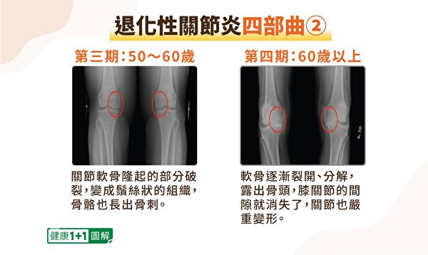 退化性关节炎第三、四期的X光片。（健康1+1／大纪元）