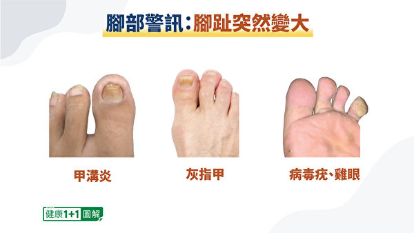 腳趾突然變大，可能是甲溝炎、灰指甲、長病毒疣或雞眼等原因。（健康1+1／大紀元）