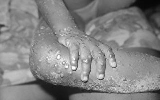 英国猴痘病例已增加至逾70例