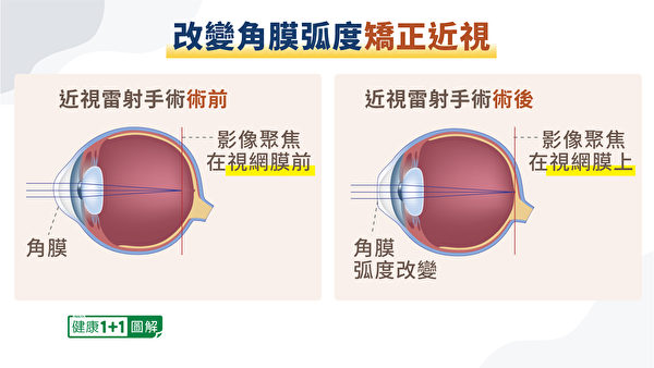 近视雷射手术可改变角膜弧度，达到矫正近视的目的。（健康1+1／大纪元）
