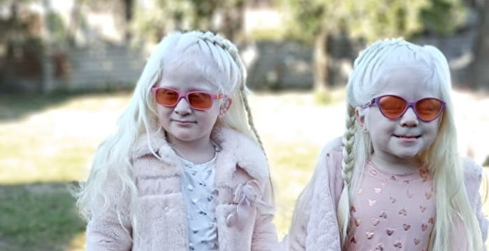 阿根廷夫妇诞下罕见白化双胞胎 但很健康