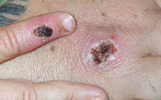 加卫生局提醒：出国时采取额外措施预防猴痘
