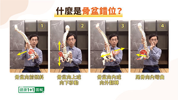 4種骨盆錯位的型態。（健康1+1／大紀元）