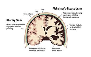 研究發現阿茲海默症澱粉樣蛋白的深層來源