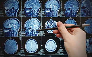 新技術：核磁共振掃描即可確診阿茲海默症