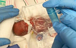 出生時僅310克 美國超早產寶寶平安回家