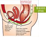 妇女尿失禁 骨盆底肌动一动避免漏尿