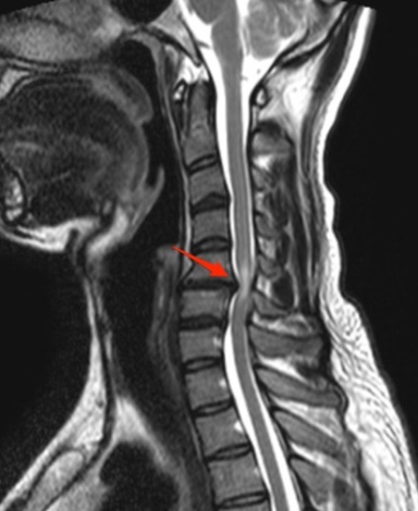 頸椎壓迫影像圖