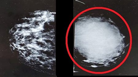 葉女士右乳正常（左圖），但左乳卻發現有巨大腫瘤（右圖紅圈處）。