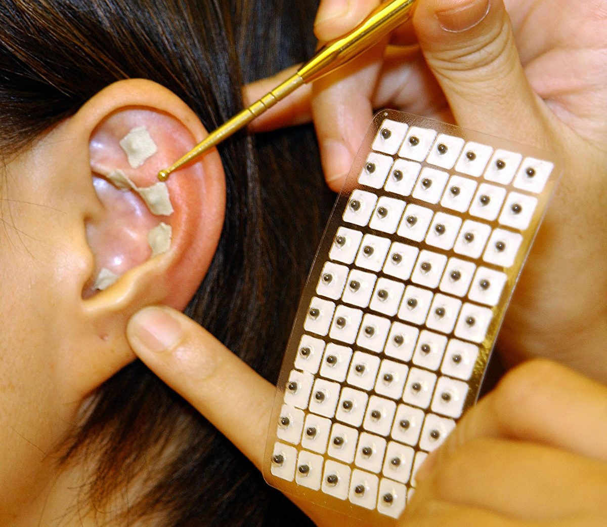 研究：中国传统耳穴疗法对妇科疾病有疗效| 王不留行| 大纪元