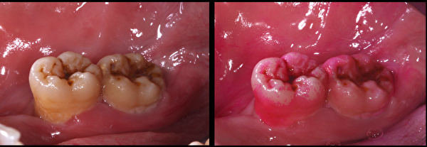 塗上牙菌斑顯示劑後，可發現牙齒內側靠近舌頭的部位有大範圍的粉紅色區塊，正是沒有刷乾淨的牙菌斑。（徐志中醫師提供）