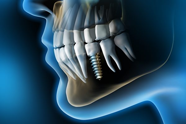 植牙亂相叢生與植牙龐大的利益、牙醫臨床訓練不足皆有關係。（Shutterstock）