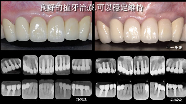 患者可以请医生提供X光片、临床照片等经由完整治疗的植牙实绩。（李明科医师提供）
