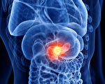 胰脏癌一发现多是晚期！警惕2个征兆 远离胰腺癌