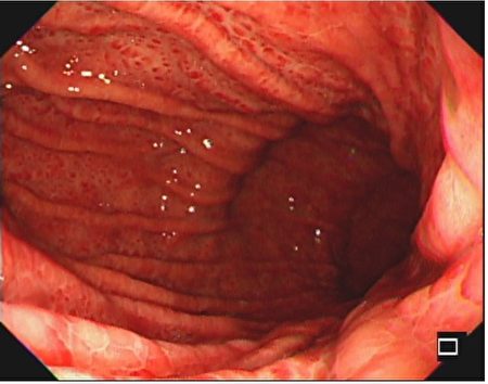 胃黏膜有蛇皮状红肿。