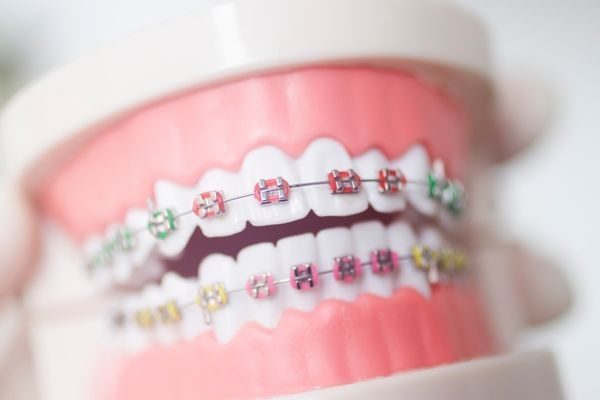 彩色牙套的皮筋环颜色可根据个人喜好进行选择