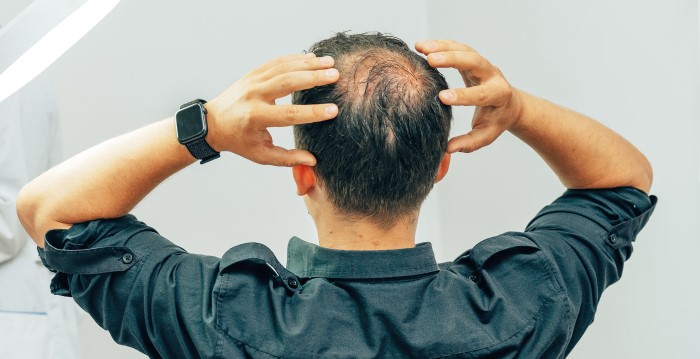 Two ways to reverse baldness: Addressing Insulin Resistance and Diabetes-induced Hair Loss from Unregulated Blood Sugar Levels in Men.