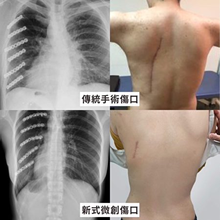 圖上為傳統肋骨骨折固定手術的x光（左上）及傷口，圖下為陳小姐所接受的新式微創肋骨骨折固定手術的x光（左下）及傷口。