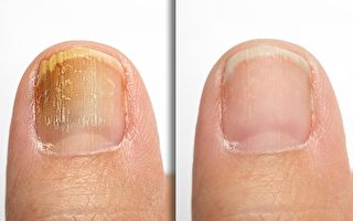 如何預防和治療灰指甲？