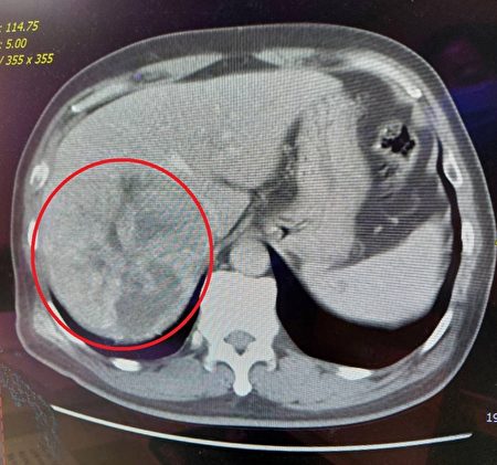 吳先生經檢查發現在肝腎右側有11分大的肝腸瘤(紅圈處)，同時壓緊下腹部靜脈。