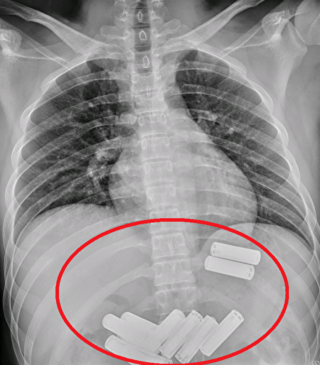 經腹部X光檢查，確認電池皆在胃中(紅圈處)。