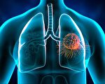医示警肺癌五大危险因子 吁相关族群定期健检