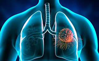 醫示警肺癌五大危險因子 籲相關族群定期健檢