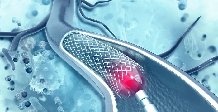 The Deceptive Benefits of Angioplasty and Stent Placement