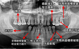 接受專業診察及早治療壞牙 預防口腔病況惡化