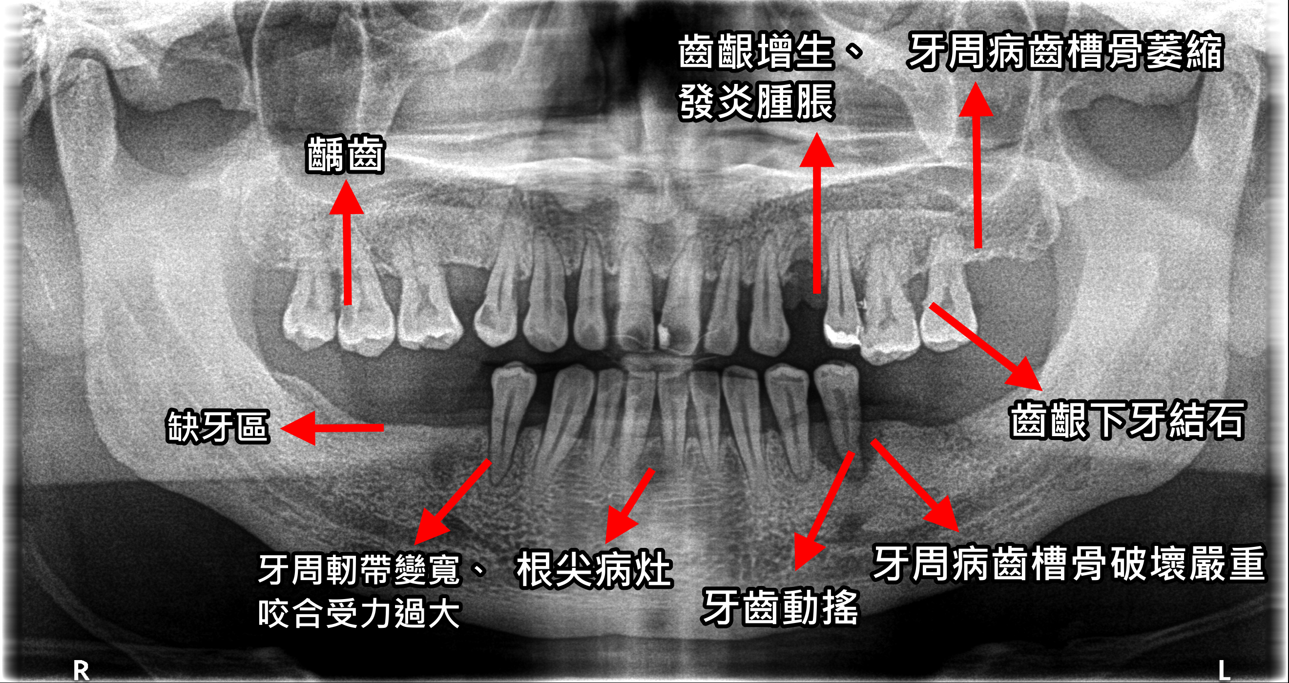 接受专业诊察及早治疗坏牙预防口腔病况恶化| 慢性病| 血管疾病| 大纪元