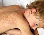 湾区卫生官员发布麻疹警告