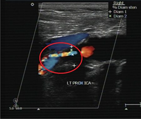 透过颈动脉超音波扫描，可协助病人及早发现颈动脉阻塞问题(红圈处)