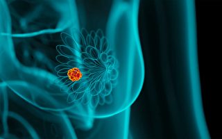 乳腺癌患者福音 药品福利计划增加新药