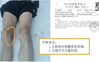 广西17岁孩子左膝长瘤医生切右膝 网友炸了