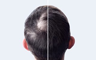 老化导致头发脱落、变白 7种营养素让头发回春