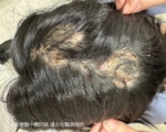 摸宠物没洗手？ 8岁童掉发、头皮化脓