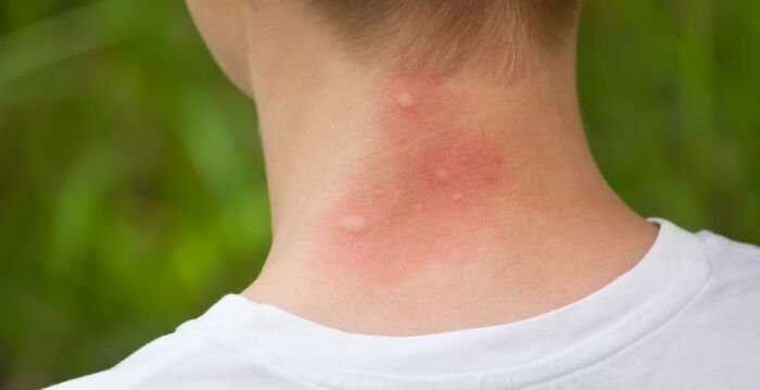 听医生的话 被蚊子叮咬后千万别做这件事