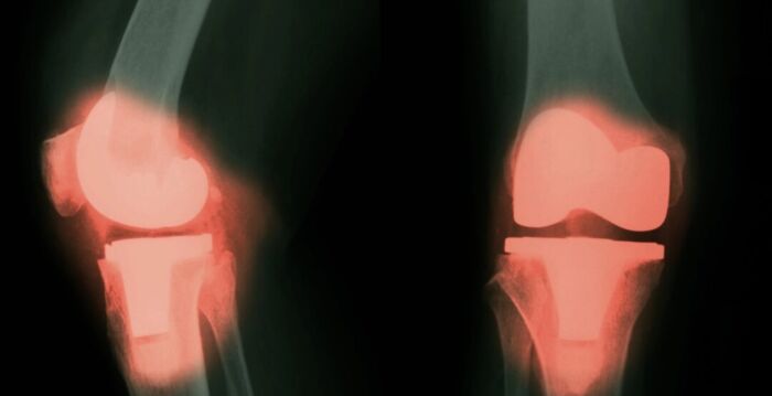 研究:植入关节中的金属恐进入血液和大脑